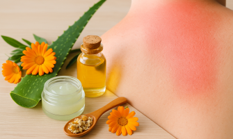 Scottature solari tutti i rimedi naturali