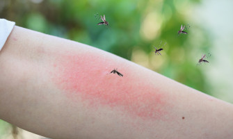 Rimedi naturali contro le punture di zanzare