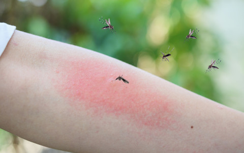 Rimedi naturali contro le punture di zanzare Rimedi naturali contro le punture di zanzare