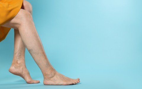 Erbe medicinali per vene varicose: scopri quali piante aiutano a combatterle naturalmente Erbe medicinali per vene varicose: scopri quali piante aiutano a combatterle naturalmente