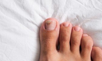 Onicomicosi: come curare la micosi alle unghie con rimedi naturali