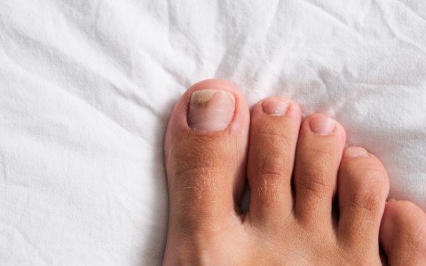 Onicomicosi: come curare la micosi alle unghie con rimedi naturali Onicomicosi: come curare la micosi alle unghie con rimedi naturali