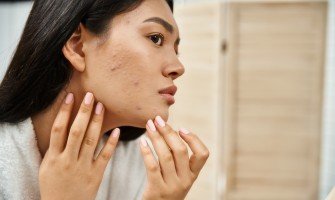 Rimedi naturali per l'acne e la pelle grassa: come curare la pelle dall'interno