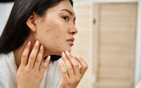 Rimedi naturali per l'acne e la pelle grassa: come curare la pelle dall'interno Rimedi naturali per l'acne e la pelle grassa: come curare la pelle dall'interno