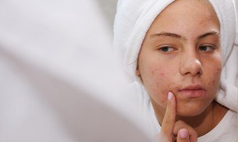 Dire addio all'acne giovanile con l'aiuto delle piante medicinali: Il ruolo della bardana e del tarassaco nella pulizia della pelle